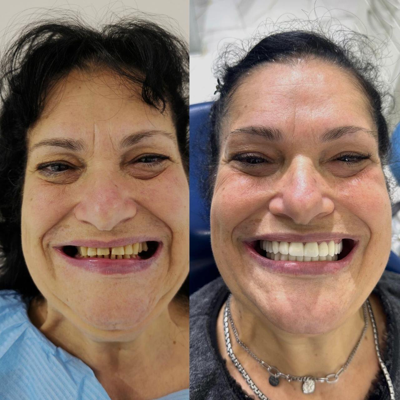 Prima e dopo caso 4